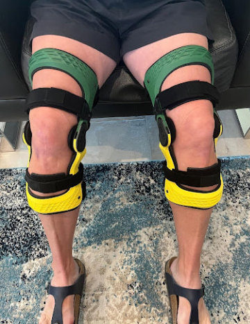 Legs of a lady wearing an Epic3D knee brace on each knee.